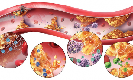 Rối loạn chuyển hóa Lipid máu là gì? Nguyên nhân & Điều Trị