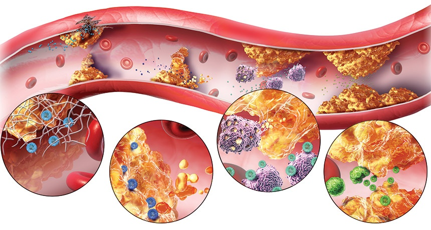 Rối loạn chuyển hóa Lipid máu là gì? Nguyên nhân & Điều Trị