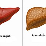 Gan nhiễm mỡ: Nguyên nhân, triệu chứng, chẩn đoán và điều trị