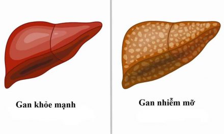 Gan nhiễm mỡ: Nguyên nhân, triệu chứng, chẩn đoán và điều trị