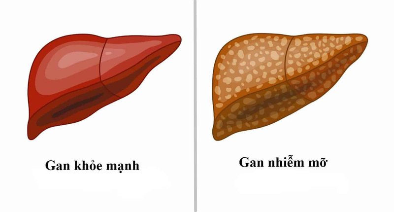 Gan nhiễm mỡ: Nguyên nhân, triệu chứng, chẩn đoán và điều trị